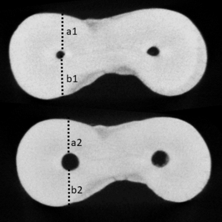 Centralização do canal radicular após preparo com ProTaper Next® e Trunatomy®: um estudo de tomografia computadorizada de feixe cônico