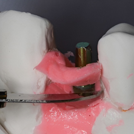 Chairside CAD/CAM workflow for implantsupported prostheses