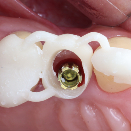 3D-Printed Crown Provisional on Single Implant: Case Report