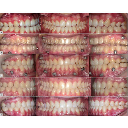 Planejamento digital de cirurgia ortognática com alinhadores: orientação orto-facial, um protocolo viável para tratamentos com benefício antecipado