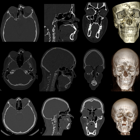 Evaluation of sinus health after treatment of fractures of the anterior wall of the frontal sinus: case series