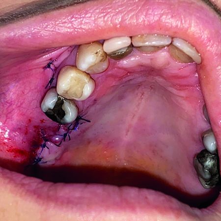 Treatment of oroantral fistula with buccal fat pad: Case Report