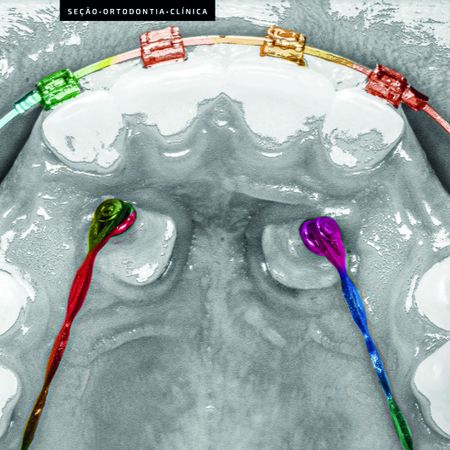 Traction of palatally impacted maxillary canines and mesialization of molars to close the space of missing second premolars: clinical case report