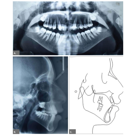 Behavioral management adaptations in orthodontic treatment of patient with autism spectrum disorder: a case report