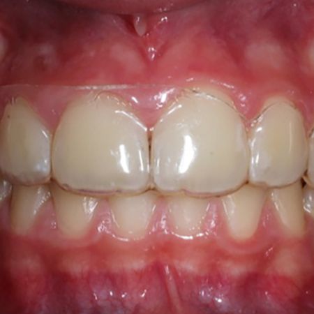 Edge level of aligners and periodontal health: a clinical perspective study in young patients