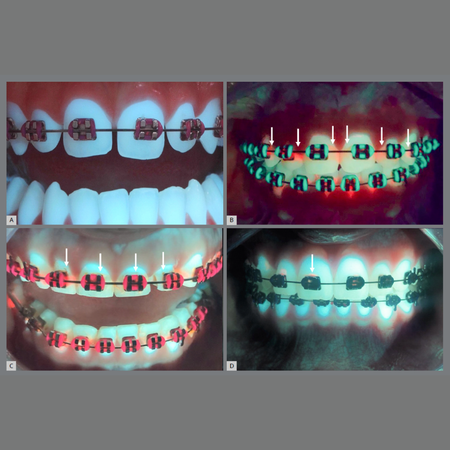 Assessment of diagnostic accuracy of reveal® autofluorescent dental loupes for detection of biofilm, demineralization, and caries around orthodontic brackets