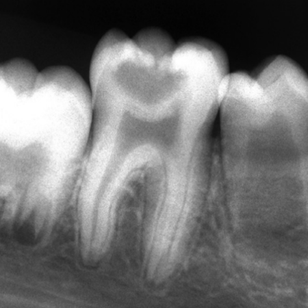 Reabsorções dentárias são sempre indolores!