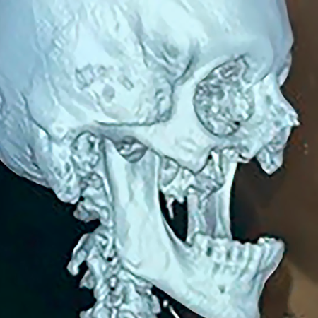 Reconstruction of bilateral maxillectomy defects in a patient with mucormycosis using customized implants and radial forearm microvascular flap: a case report
