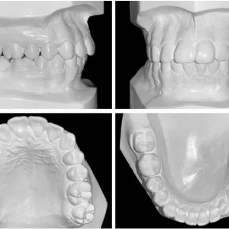 Approach to severe skeletal Class II malocclusion associated with mandibular deficiency: case report