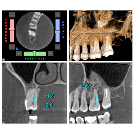 CBCT analysis of the prevalence and morphology of a second canal in the palatal roots of maxillary first and second molars