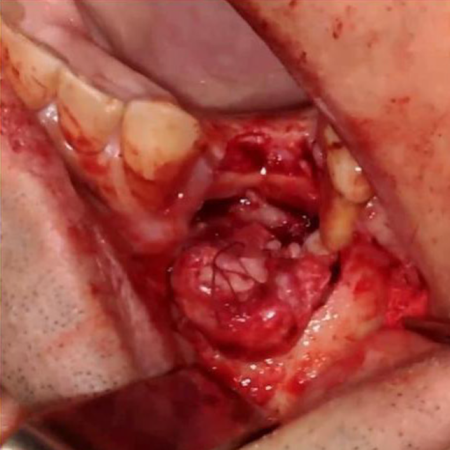 Three-step closure of an oroantral fistula: a case report