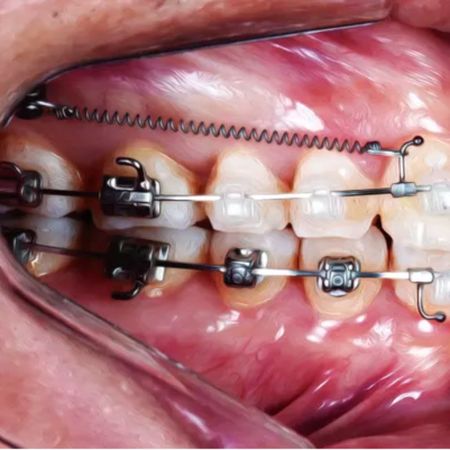 Treatment of Class II subdivision using extraalveolar miniscrews in the infrazygomatic crest associated with self-ligating appliances with individualized prescription: case report