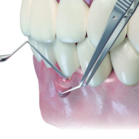 Intra- and extraorally de-epithelialized connective tissue graft: case report with 4-year follow-up