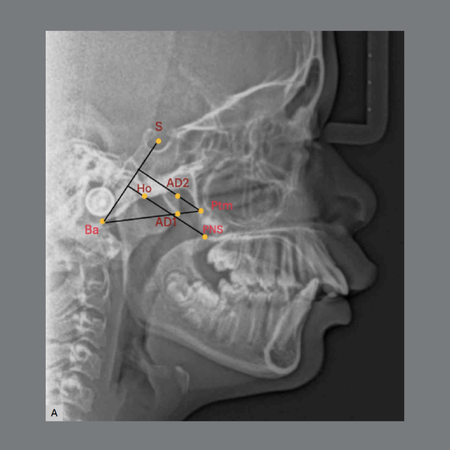 A 25-year evaluation of pharyngeal airways dimensional changes after headgear orthopedic treatment
