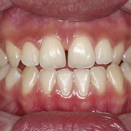 Compensatory orthodontic treatment of Class III malocclusion with the aid of temporary anchorage devices: case report