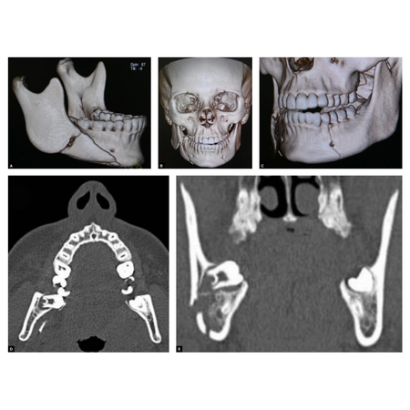 Carga suportada ou carga compartilhada, em fratura da mandíbula que envolve terceiro molar?