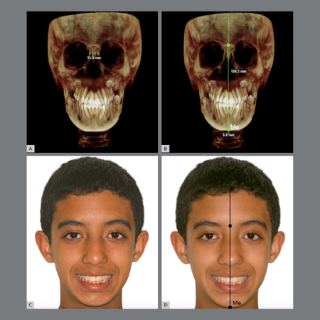 Assessment of the relationship between facial, skeletal, dental and smile asymmetries: a preliminary investigative analysis