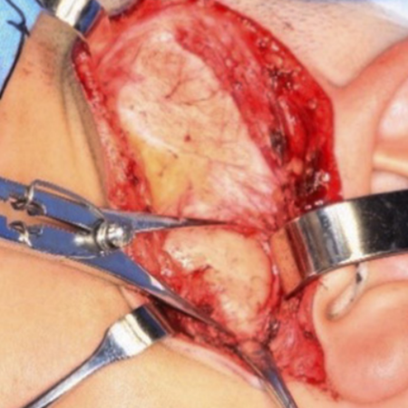 Frey syndrome after surgery for the treatment of temporomandibular joint ankylosis: case report