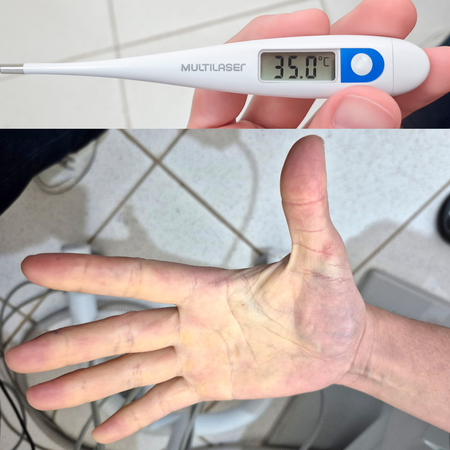Raynaud's phenomenon and Dentistry: case report