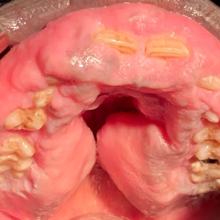 A 3-year follow-up of a non-syndromic gingival fibromatosis in a sub-Saharian male in Mauritania: a rare clinical case report