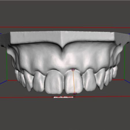 Avaliação da precisão e acurácia de modelos odontológicos digitais com um dispositivo de luz estruturada de baixo custo