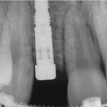 Implant-supported prosthesis in place of congenitally missing maxillary lateral incisor: Case report with 16-years follow-up