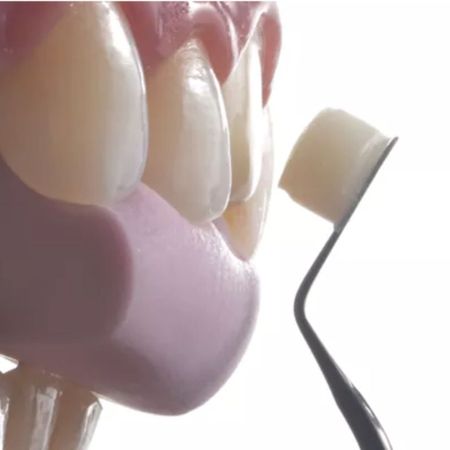 Single darkened central incisor: One of the greatest challenges in esthetic restorative dentistry