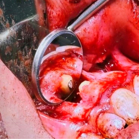 Parendodontic surgery in an immature tooth: case report