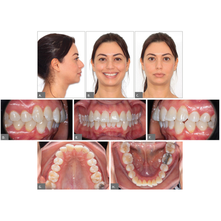 Optimizing clear aligner outcomes with auxiliary mechanics: case reports