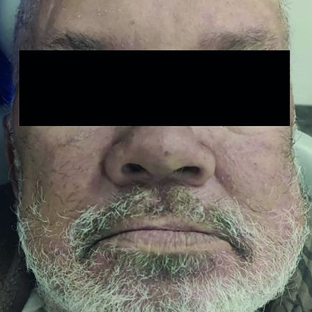 Osteomyelitis as a complication of face trauma in a patient with systemic decompensation