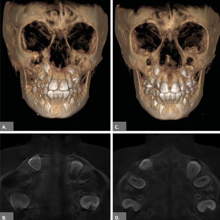 Expansor palatino Invisalign: una nueva opción para una expansión rápida de la maxila en pacientes en crecimiento