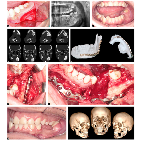 Intraoral approach for mandibular marginal resection: case report