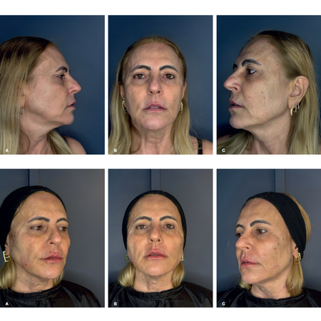 Tratamento fullface em paciente com doenças autoimunes: síndrome de Sjögren, Hashimoto e fibromialgia