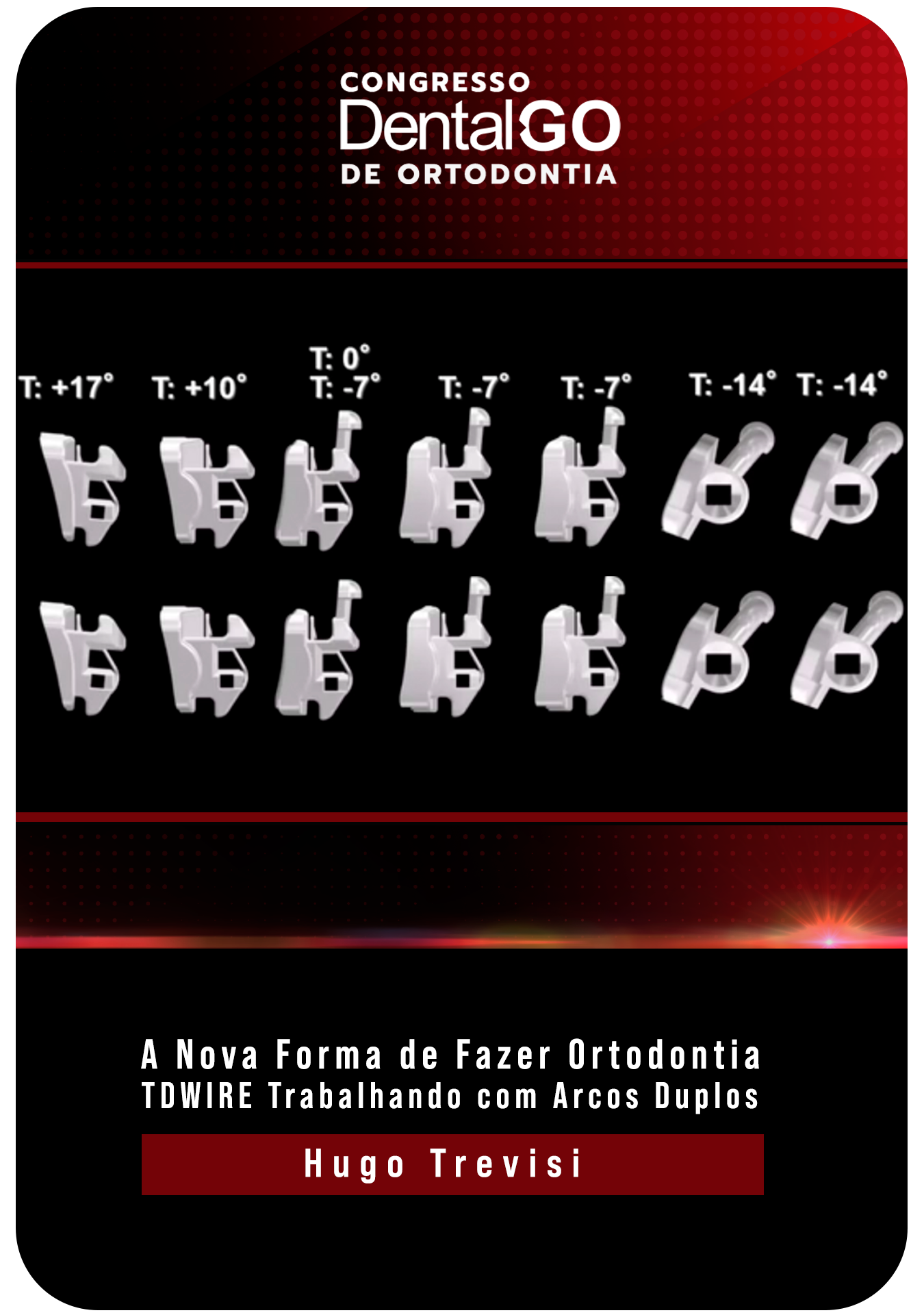 A Nova Forma de Fazer Ortodontia - TDWIRE Trabalhando com Arcos Duplos - Hugo Trevisi