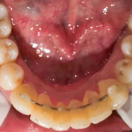 Comparison of multistranded wire and fiber-reinforced composite retainers effects on periodontium: A randomized clinical trial