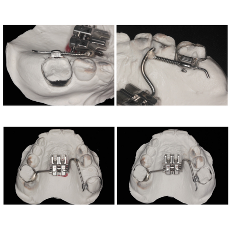 How to make a hybrid expander for distalization and space recovery