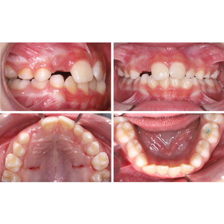 Criatividade na individualização de um miniexpansor Hyrax para o tratamento de mordida cruzada posterior em dentição mista