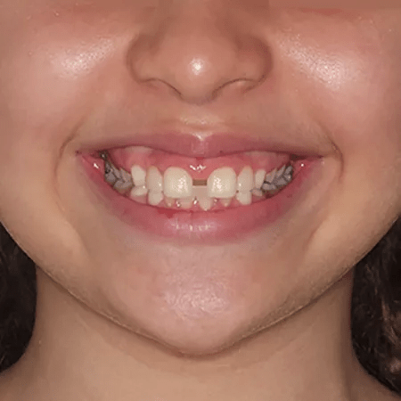 ¿La presencia de diastema mediano influye en la percepción de la estética dentofacial en los niños?