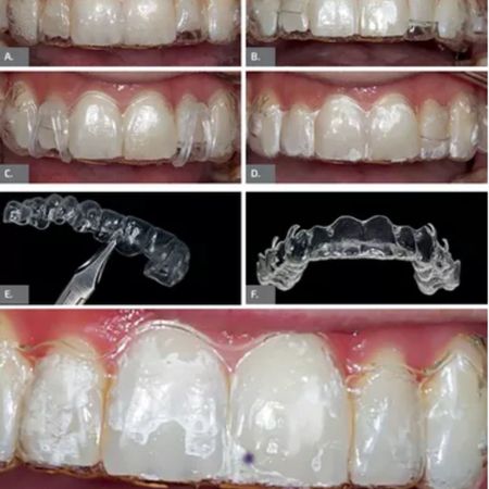 Use of Bootstrap, Pin-lock and Double-Wedge in tracking resolution in aligner treatment