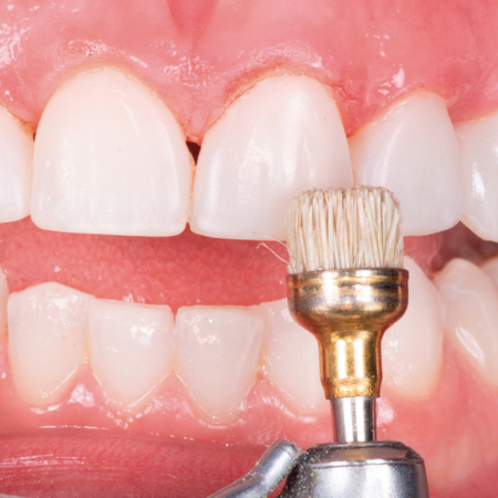 Restoring smile esthetics with composite resin in a patient with conoid teeth