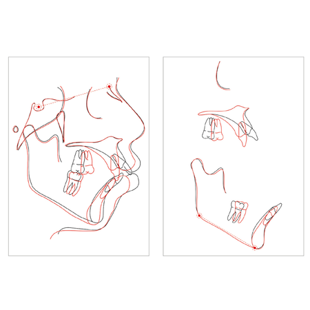 Tratamiento compensatorio de la maloclusión de Clase II hiperdivergente: reporte de un caso