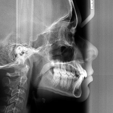Mandibular incisor extraction treatment in a young patient with Friedreich’s ataxia: A case report