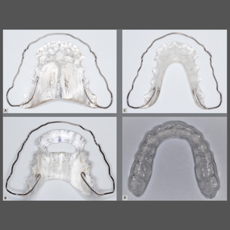 Comparison of speech changes caused by four different orthodontic retainers: a crossover randomized clinical trial