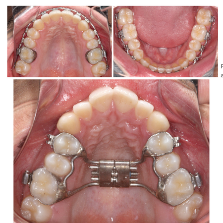 Impression for orthodontic band transfer for manufacturing soldered appliances on working models
