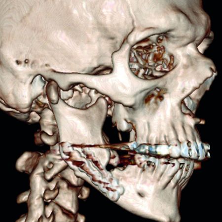 Iatrogenic mandibular angle fracture and extractor: case report