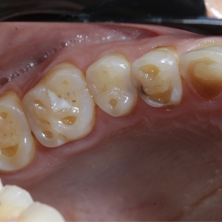 Impact of Electronic Cigarette Use on Oral and Systemic Health: Case Report and Literature Review