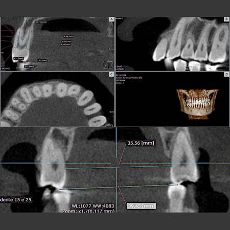 Dimensional changes of alveolar bone after orthodontic expansion with Invisalign® aligners: study by Cone Beam Computed Tomography