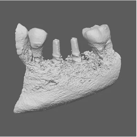 Bone volumetric changes in atrophic jaws after bone reconstruction using rhBMP-2/ACS in association with bovine bone substitute: A long-term follow-up case series