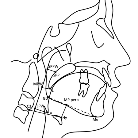 Long-term evaluation (10 years) of the outcomes of Herbst functional appliance in pharyngeal dimensions and hyoid bone position