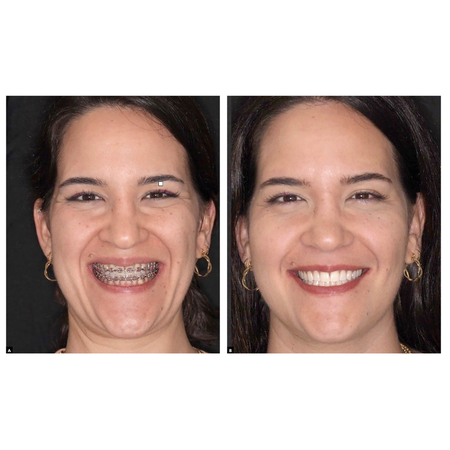 The challenge of reintervention in orthognathic surgery: case report